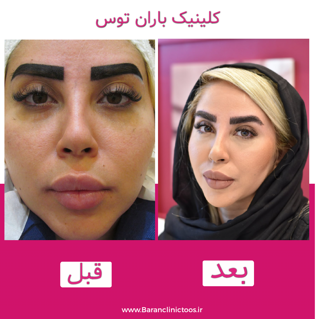 قبل و بعد کاشت ابرو روی تتو